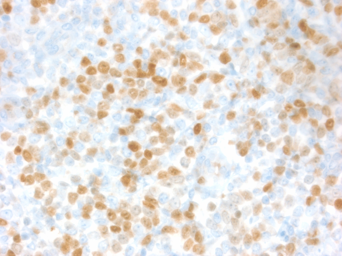 Skin Biopsy: TdT immunohistochemical stain, 400x